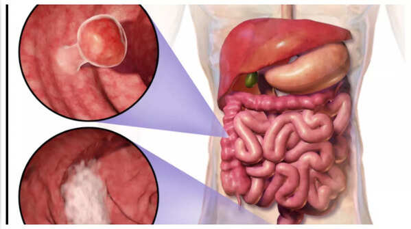 Blood in stool as a symptom